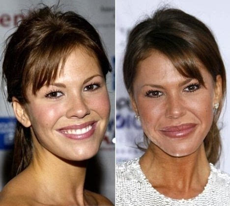 做隆胸手术死亡 细数整容失败女星最惨丧命