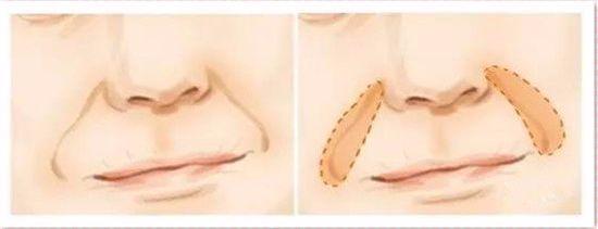 北京伊美尔幸福医院:玻尿酸除皱多少钱一次