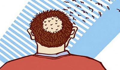 合肥新生植发张春杰院长解答：斑秃应该如何治疗比较好