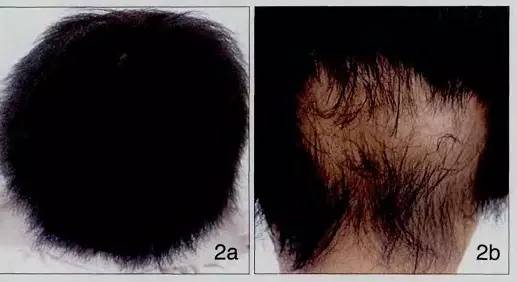 少年秃顶:关于儿童斑秃不得不说的事儿