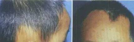 少年秃顶:关于儿童斑秃不得不说的事儿