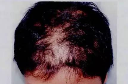 少年秃顶:关于儿童斑秃不得不说的事儿