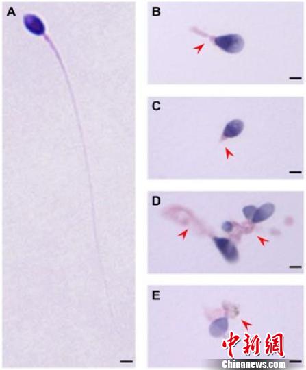 正常精子形态(A)和TTC21A基因缺陷患者的精子形态(B-E)。研究图