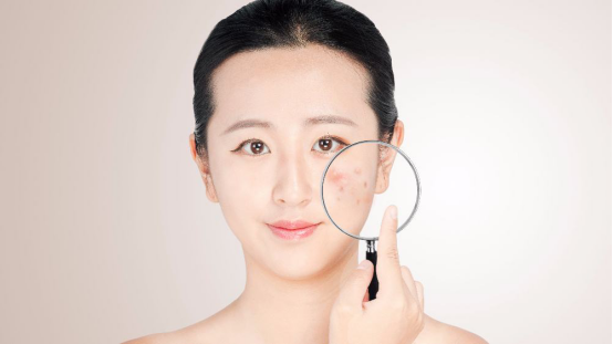 为什么痘痘总是反复发作？主要是这3个原因导致