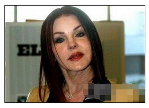 打肉毒素变面瘫 整容有风险