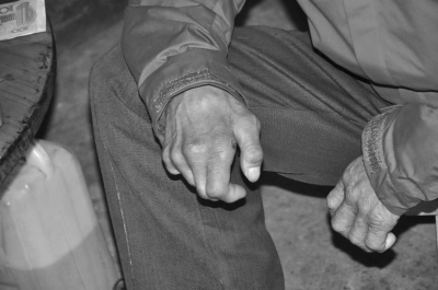 他们并不可怕——写在“世界防治麻风病日”