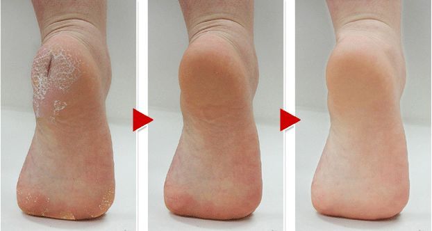 这个让脚层层脱皮的足膜,一边忍着恶心一边用