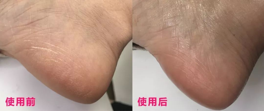 这个让脚层层脱皮的足膜,一边忍着恶心一边用