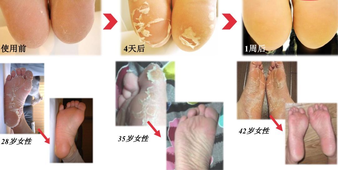 这个让脚层层脱皮的足膜,一边忍着恶心一边用