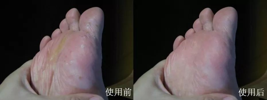 这个让脚层层脱皮的足膜,一边忍着恶心一边用