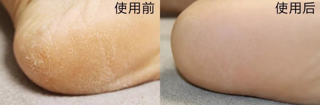 这个让脚层层脱皮的足膜,一边忍着恶心一边用