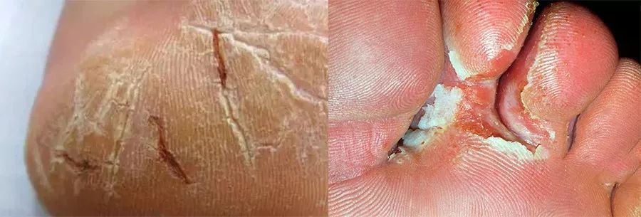 这个让脚层层脱皮的足膜,一边忍着恶心一边用