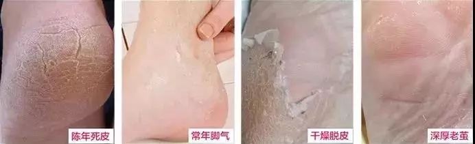 这个让脚层层脱皮的足膜,一边忍着恶心一边用