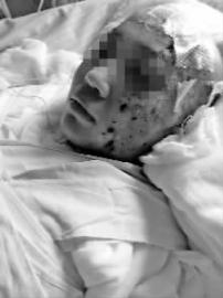 烧伤超50天已进入感染期脱离危险期大概还需50万