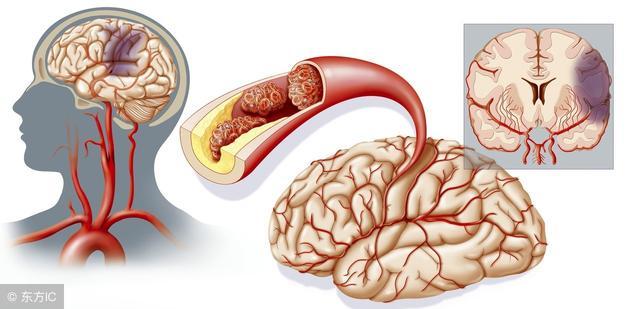 缓解脑梗塞患者头疼的方法是什么