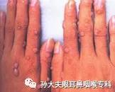 电离子治疗仪轻松治疗扁平疣