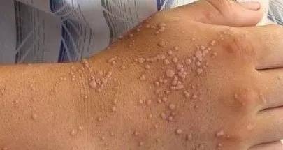 电离子治疗仪轻松治疗扁平疣