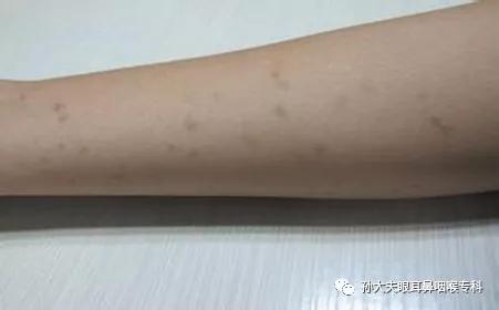 电离子治疗仪轻松治疗扁平疣