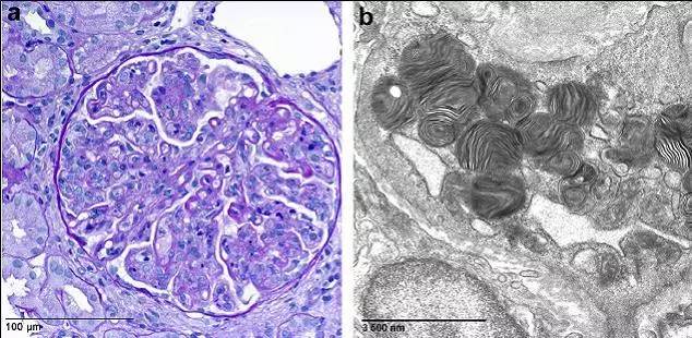 狼疮患者的肾活检标本中出现髓样小体一例