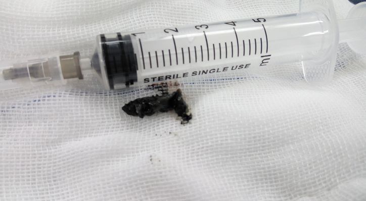 惊!4岁宝宝睡觉打鼾,突然没了呼吸!医生从身上取出这东西