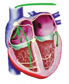 点击查看大图 心衰不可逆 及早干预远离猝死