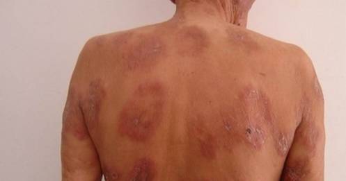 【世界麻风病日】消除麻风危害，莒县正在加速行动中！