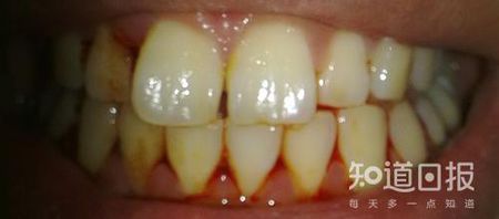 科普：为什么牙龈出血比大姨妈还要频繁？