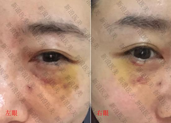 连化妆磨皮都没办法遮住的眼袋 小编这次终于把它除掉了