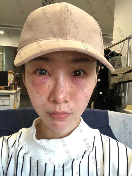 连化妆磨皮都没办法遮住的眼袋 小编这次终于把它除掉了