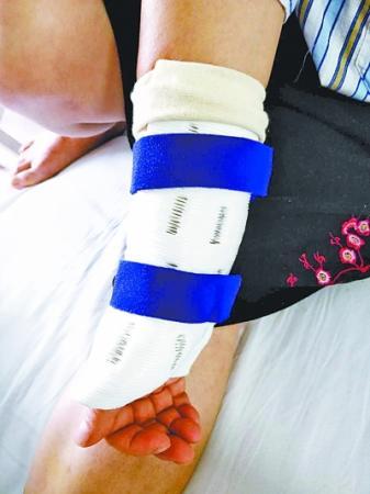 武汉首个玉米淀粉3D打印支具“上手”