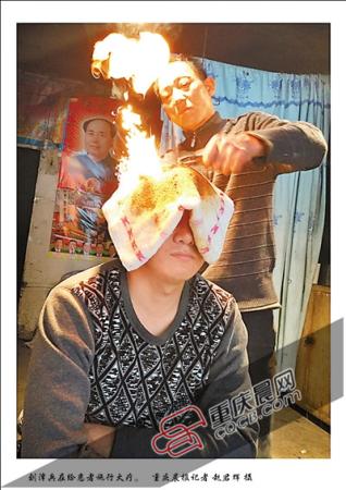 火疗治顽固性头痛现场目击：毛巾包头烧火（图）