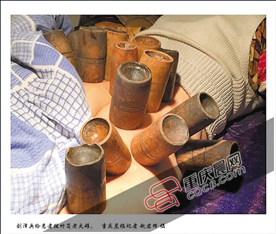 火疗治顽固性头痛现场目击：毛巾包头烧火（图）