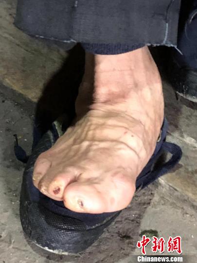 麻风村一位老人虽然已经治愈,但脚已变形。 王祖敏 摄 麻风村一位老人虽然已经治愈,但脚已变形。 王祖敏 摄