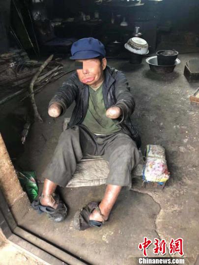 麻风村的村民。　中国残疾人福利基金会供图 摄