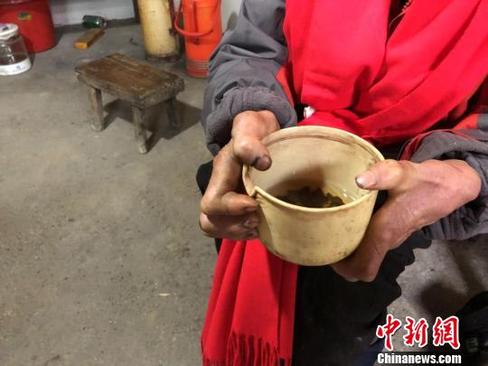 薛大爷端着茶碗的手严重变形。　王祖敏 摄