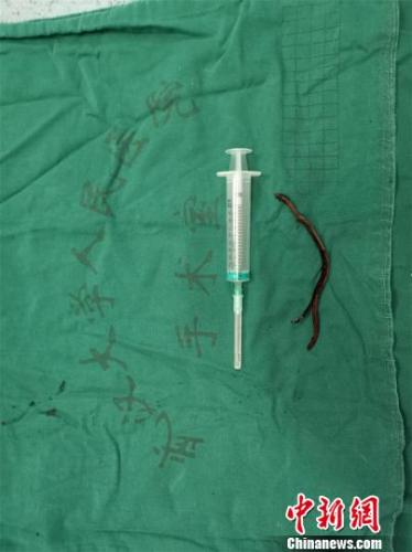 拔出的金属异物。院方供图