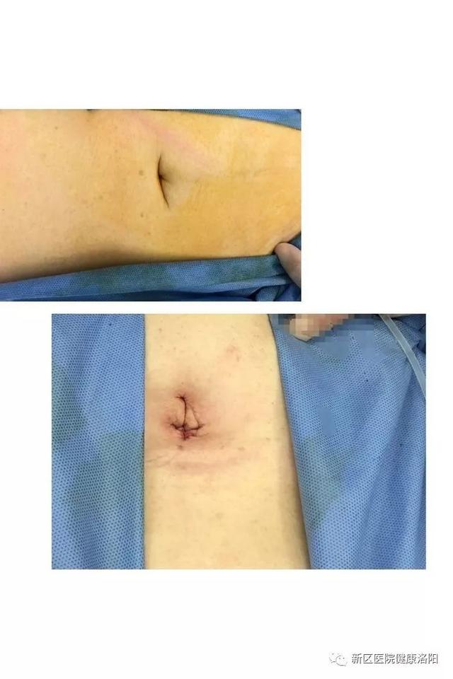 神秘消失的手术刀口